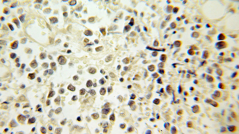 Immunohistochemical of paraffin-embedded human lymphoma using Catalog No:110408(ERCC2 antibody) at dilution of 1:100 (under 10x lens)