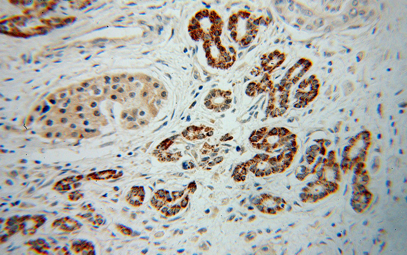 Immunohistochemical of paraffin-embedded human pancreas cancer using Catalog No:113192(NIT1 antibody) at dilution of 1:50 (under 10x lens)