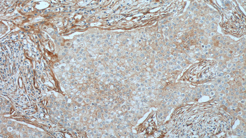 Immunohistochemistry of paraffin-embedded human breast cancer tissue slide using Catalog No:117346(Vinculin Antibody) at dilution of 1:200 (under 10x lens). heat mediated antigen retrieved with Tris-EDTA buffer(pH9).