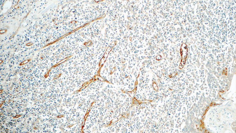 Immunohistochemistry of paraffin-embedded human tonsillitis tissue slide using Catalog No:109386(CLEC4M Antibody) at dilution of 1:50 (under 10x lens)