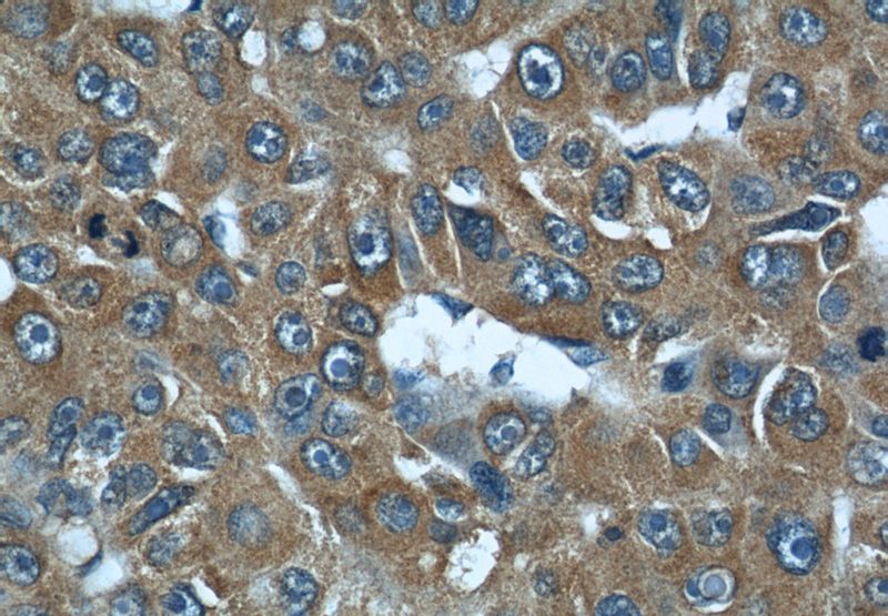 Immunohistochemical of paraffin-embedded human liver cancer using Catalog No:109892(DEPDC6 antibody) at dilution of 1:50 (under 40x lens)