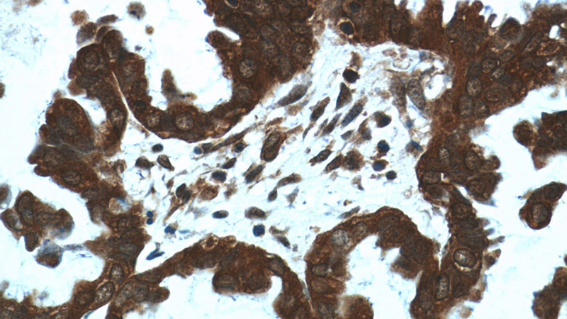 Immunohistochemistry of paraffin-embedded human ovary tumor tissue slide using Catalog No:110201(EIF4A2 Antibody) at dilution of 1:50 (under 40x lens)