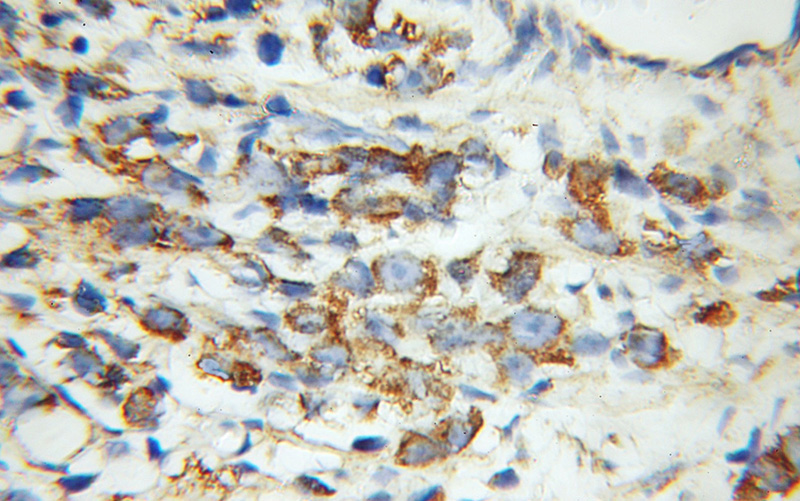 Immunohistochemical of paraffin-embedded human prostate cancer using Catalog No:116730(VDAC2 antibody) at dilution of 1:100 (under 40x lens)