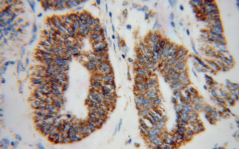 Immunohistochemical of paraffin-embedded human liver cancer using Catalog No:111184(GSTK1 antibody) at dilution of 1:100 (under 40x lens)
