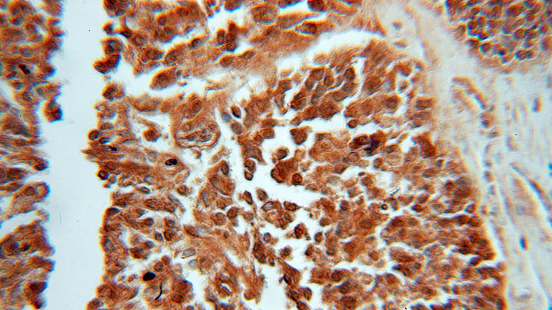 Immunohistochemical of paraffin-embedded human ovary tumor using Catalog No:109462(COPS2 antibody) at dilution of 1:50 (under 10x lens)