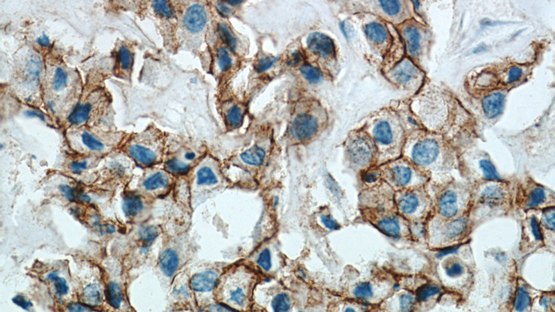 Immunohistochemical of paraffin-embedded human breast cancer using Catalog No:107956(ALCAM antibody) at dilution of 1:50 (under 40x lens)