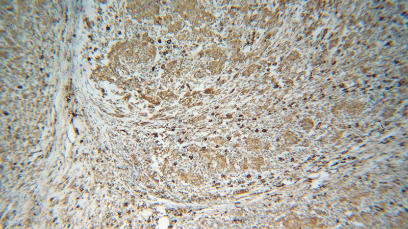 Immunohistochemical of paraffin-embedded human breast cancer using Catalog No:111223(HSP90B1 antibody) at dilution of 1:100 (under 10x lens)