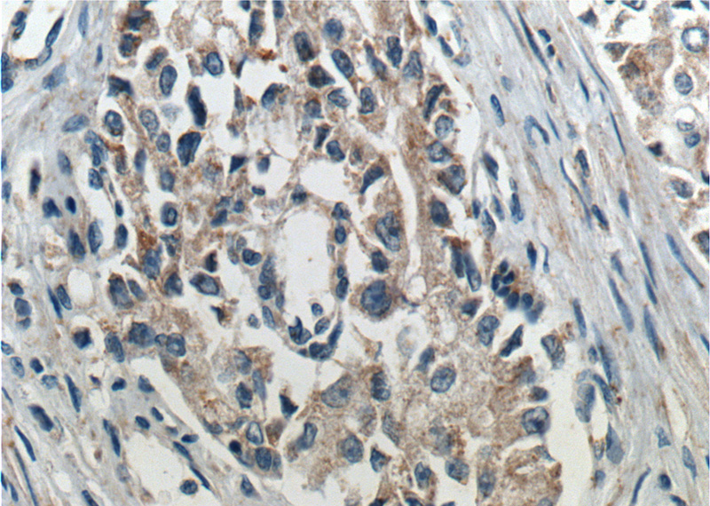 Immunohistochemistry of paraffin-embedded human prostate cancer tissue slide using Catalog No:114264(PTEN Antibody) at dilution of 1:200 (under 40x lens). heat mediated antigen retrieved with Tris-EDTA buffer(pH9).