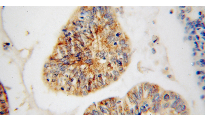 Immunohistochemical of paraffin-embedded human colon cancer using Catalog No:114695(RIBC2 antibody) at dilution of 1:50 (under 40x lens)