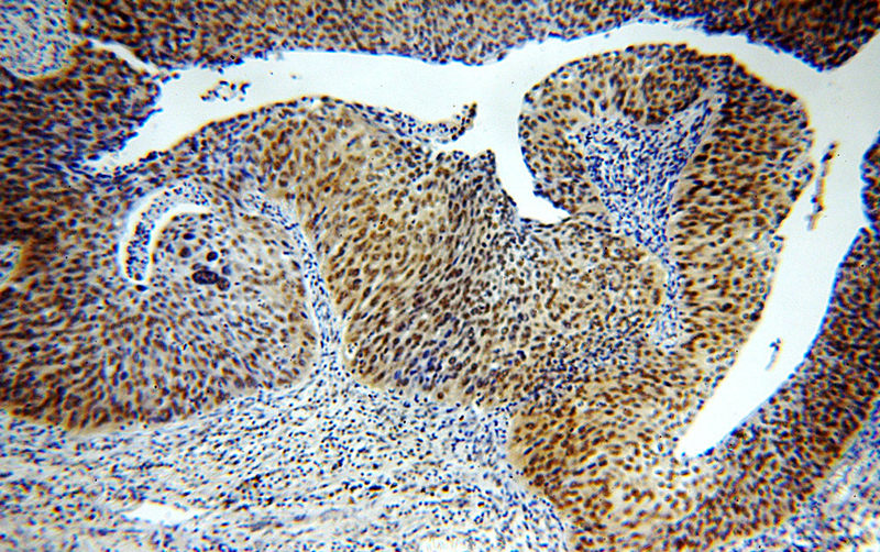 Immunohistochemical of paraffin-embedded human cervical cancer using Catalog No:115671(STAG2 antibody) at dilution of 1:100 (under 10x lens)