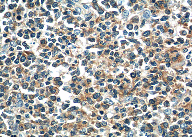 Immunohistochemistry of paraffin-embedded human tonsillitis tissue slide using Catalog No:109848(DEF6 Antibody) at dilution of 1:50 (under 40x lens)