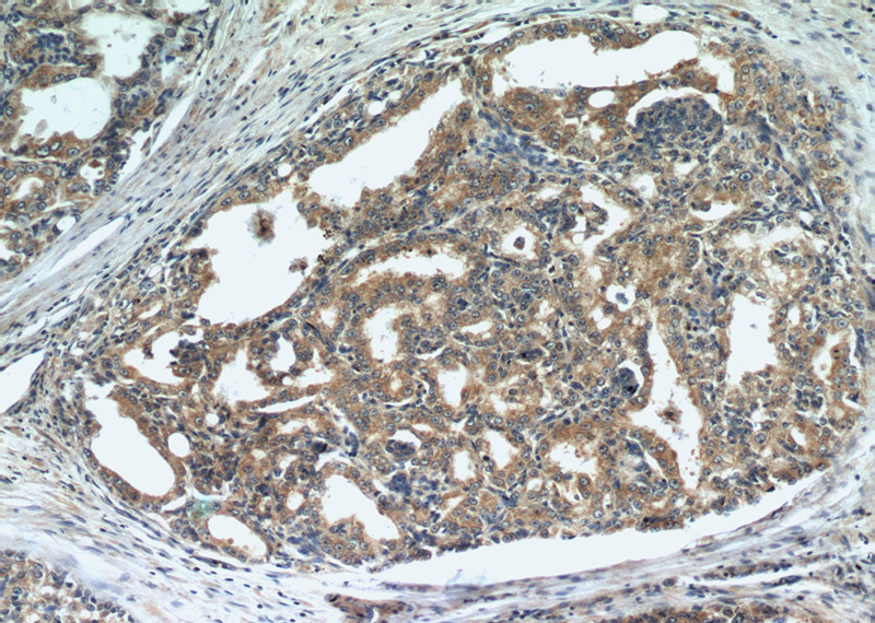 Immunohistochemical of paraffin-embedded human prostate cancer using Catalog No:115725(STK4 antibody) at dilution of 1:50 (under 10x lens)