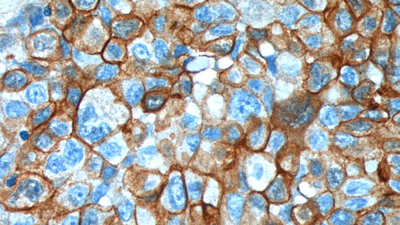 Immunohistochemistry of paraffin-embedded human lung cancer tissue slide using Catalog No:114954(S100A10 Antibody) at dilution of 1:400 (under 40x lens).