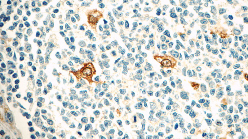 Immunohistochemistry of paraffin-embedded human tonsillitis tissue slide using Catalog No:109384(CLEC4D Antibody) at dilution of 1:50 (under 40x lens)