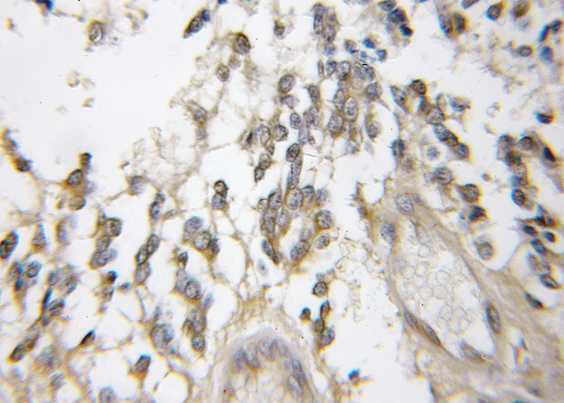 Immunohistochemical of paraffin-embedded human gliomas using Catalog No:109494(COX6B1 antibody) at dilution of 1:50 (under 10x lens)