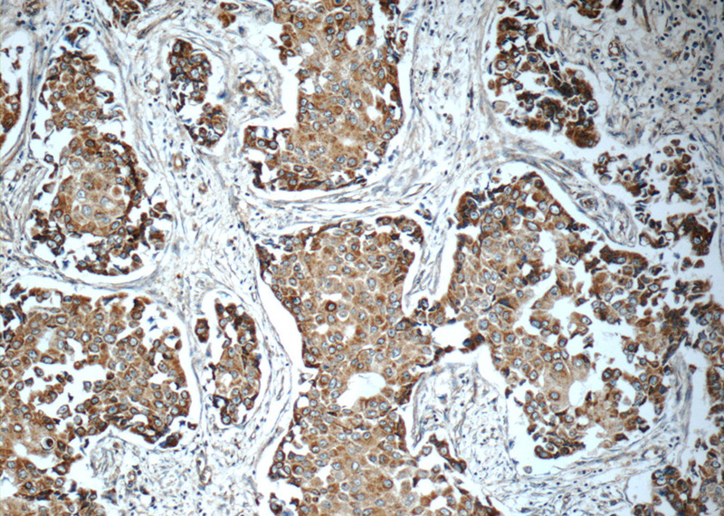 Immunohistochemistry of paraffin-embedded human breast cancer tissue slide using Catalog No:116141(Timp-3 Antibody) at dilution of 1:50 (under 10x lens)