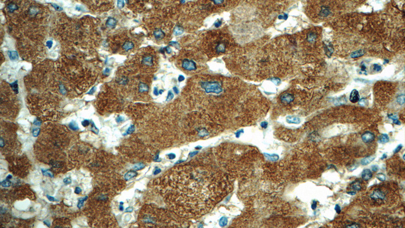 Immunohistochemistry of paraffin-embedded human hepatocirrhosis tissue slide using Catalog No:109903(DGAT1 Antibody) at dilution of 1:50 (under 40x lens)