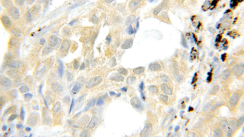 Immunohistochemical of paraffin-embedded human lung cancer using Catalog No:115145(SFRP2 antibody) at dilution of 1:50 (under 10x lens)
