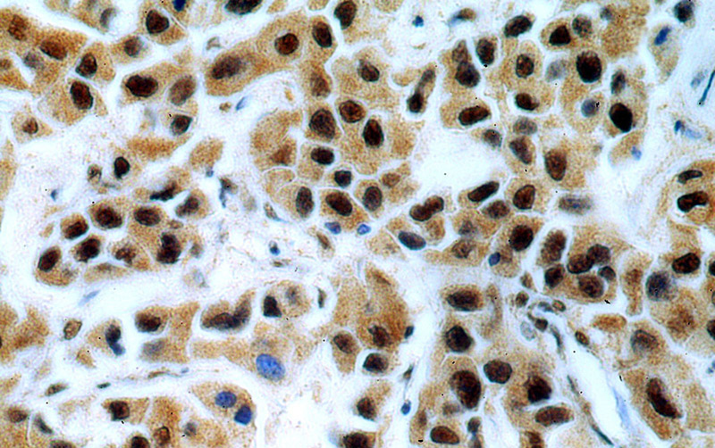 Immunohistochemical of paraffin-embedded human breast cancer using Catalog No:117224(BRCA1 antibody) at dilution of 1:100 (under 40x lens)