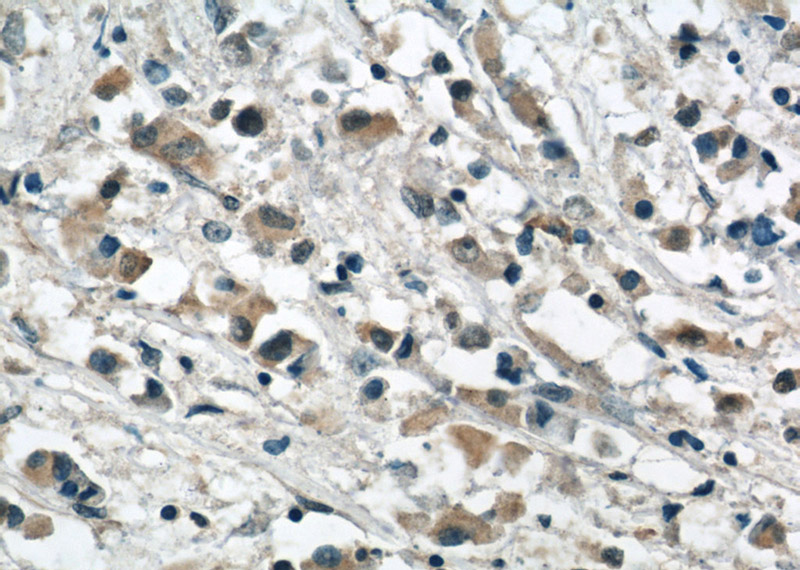 Immunohistochemical of paraffin-embedded human breast cancer using Catalog No:107063(APOBEC3G antibody) at dilution of 1:50 (under 40x lens)