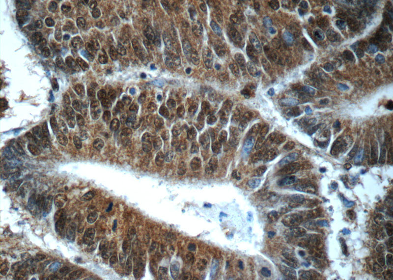 Immunohistochemistry of paraffin-embedded human colon cancer tissue slide using Catalog No:111371(HDAC10 Antibody) at dilution of 1:50 (under 40x lens)