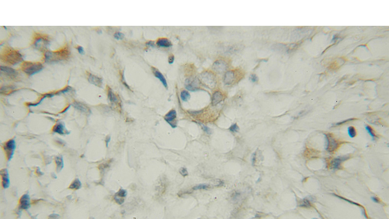 Immunohistochemical of paraffin-embedded human breast cancer using Catalog No:116785(VPS37A antibody) at dilution of 1:50 (under 10x lens)