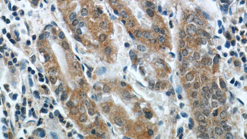 Immunohistochemical of paraffin-embedded human stomach using Catalog No:113383(NUP85 antibody) at dilution of 1:50 (under 40x lens)