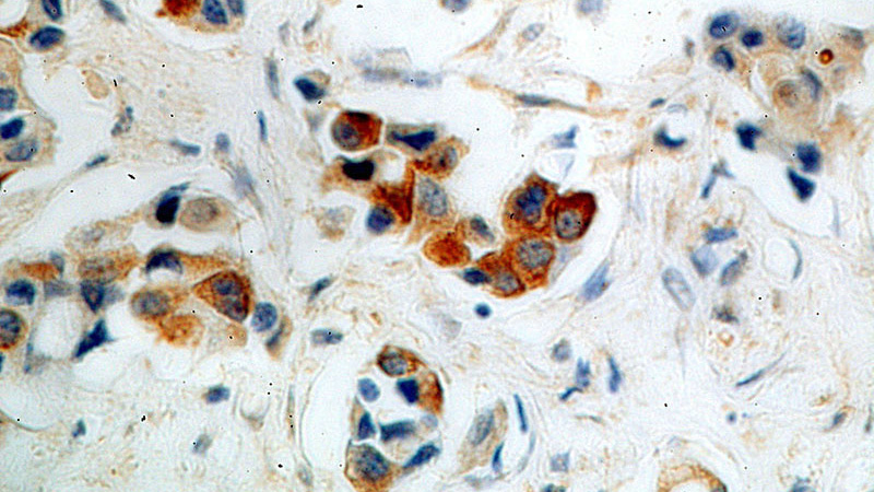 Immunohistochemical of paraffin-embedded human breast cancer using Catalog No:110636(FGF8 antibody) at dilution of 1:50 (under 40x lens)