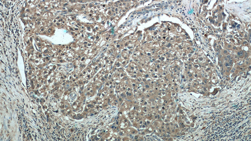 Immunohistochemistry of paraffin-embedded human liver cancer tissue slide using Catalog No:109917(DHFR Antibody) at dilution of 1:50 (under 10x lens)