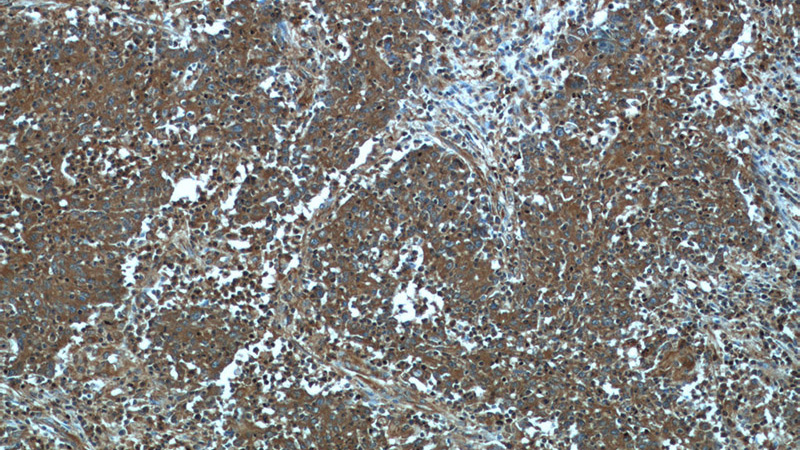 Immunohistochemistry of paraffin-embedded human colon cancer tissue slide using Catalog No:112129(KRT23 Antibody) at dilution of 1:50 (under 10x lens)
