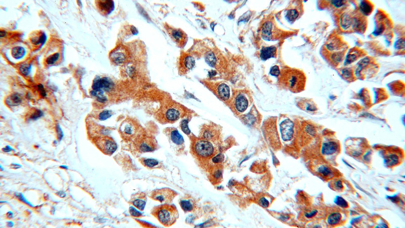 Immunohistochemical of paraffin-embedded human breast cancer using Catalog No:112125(KRT10 antibody) at dilution of 1:50 (under 40x lens)