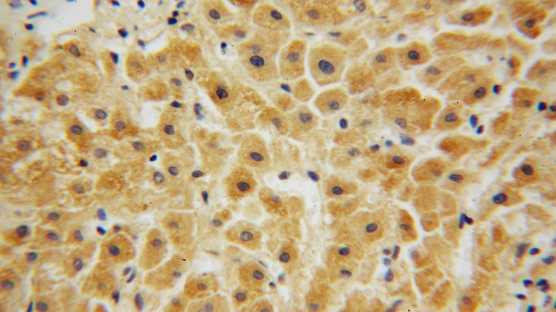 Immunohistochemical of paraffin-embedded human liver cancer using Catalog No:113771(PFKL antibody) at dilution of 1:50 (under 40x lens)