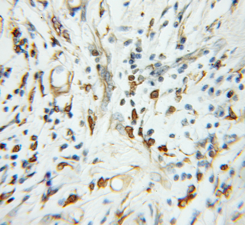 Immunohistochemical of paraffin-embedded human colon cancer using Catalog No:115975(TADA2L antibody) at dilution of 1:50 (under 10x lens)