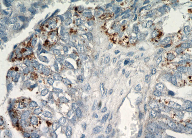 Immunohistochemical of paraffin-embedded human ovary tumor using Catalog No:109225(CHI3L1 antibody) at dilution of 1:50 (under 40x lens)