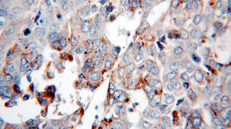 Immunohistochemical of paraffin-embedded human liver cancer using Catalog No:114289(PSAP antibody) at dilution of 1:100 (under 40x lens)