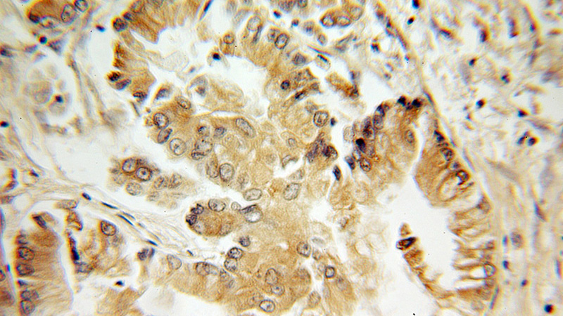 Immunohistochemical of paraffin-embedded human lung cancer using Catalog No:116279(TMS1 antibody) at dilution of 1:100 (under 10x lens)