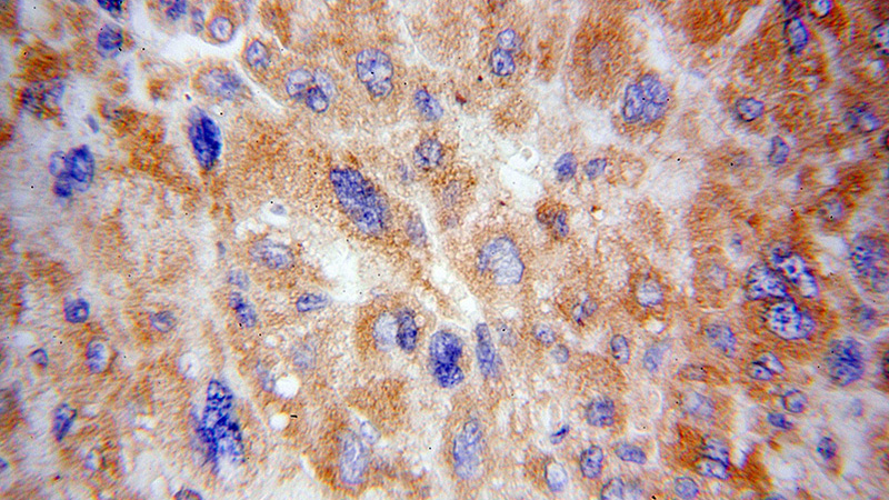 Immunohistochemical of paraffin-embedded human liver cancer using Catalog No:114830(RPS15 antibody) at dilution of 1:100 (under 40x lens)