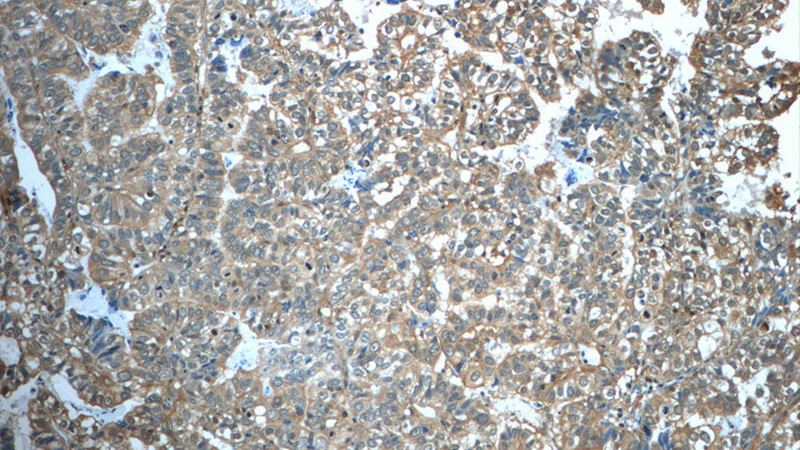 Immunohistochemistry of paraffin-embedded human breast cancer tissue slide using Catalog No:109201(CFTR Antibody) at dilution of 1:50 (under 10x lens)