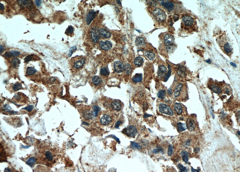 Immunohistochemical of paraffin-embedded human breast cancer using Catalog No:111247(GTSE1 antibody) at dilution of 1:50 (under 40x lens)