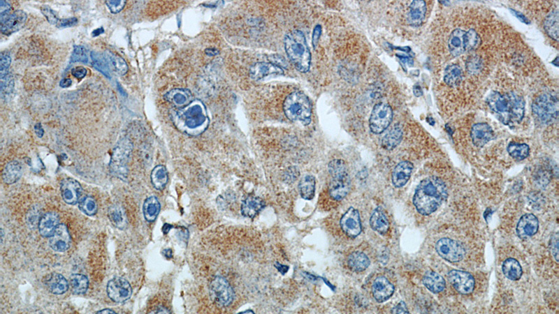 Immunohistochemical of paraffin-embedded human liver cancer using Catalog No:114005(PLOD2 antibody) at dilution of 1:50 (under 40x lens)