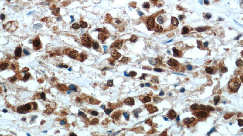 Immunohistochemical of paraffin-embedded human breast cancer using Catalog No:112152(LASP1 antibody) at dilution of 1:100 (under 40x lens)