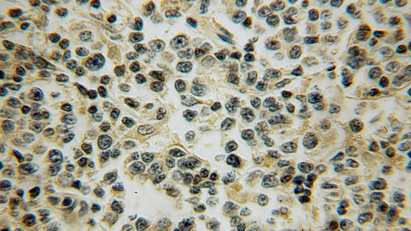 Immunohistochemical of paraffin-embedded human lymphoma using Catalog No:109150(CD97 antibody) at dilution of 1:100 (under 10x lens)