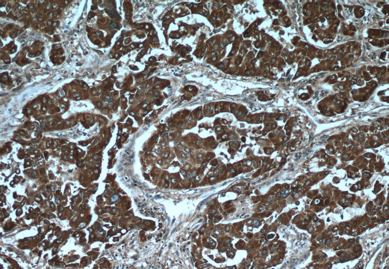 Immunohistochemistry of paraffin-embedded human liver cancer tissue slide using Catalog No:108561(C10orf125 Antibody) at dilution of 1:50 (under 10x lens)
