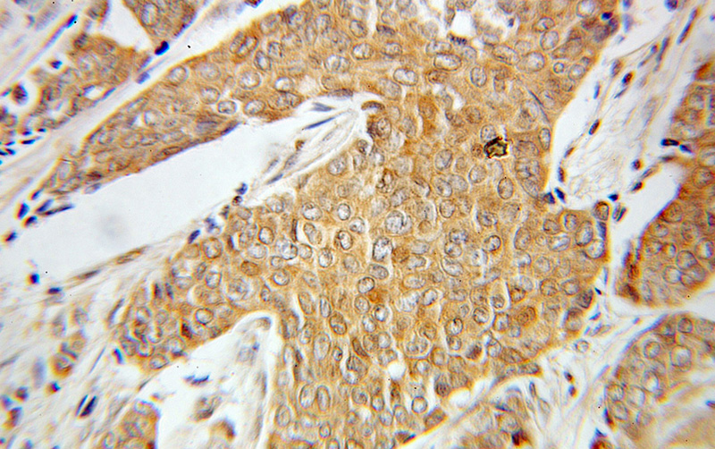 Immunohistochemical of paraffin-embedded human breast cancer using Catalog No:113853(PRKCZ antibody) at dilution of 1:100 (under 10x lens)