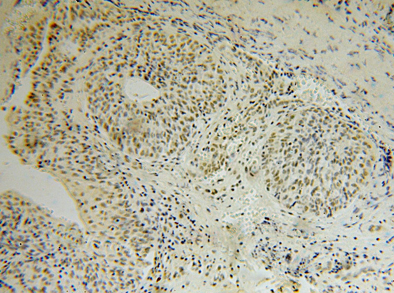Immunohistochemical of paraffin-embedded human colon cancer using Catalog No:116166(TOE1 antibody) at dilution of 1:50 (under 10x lens)