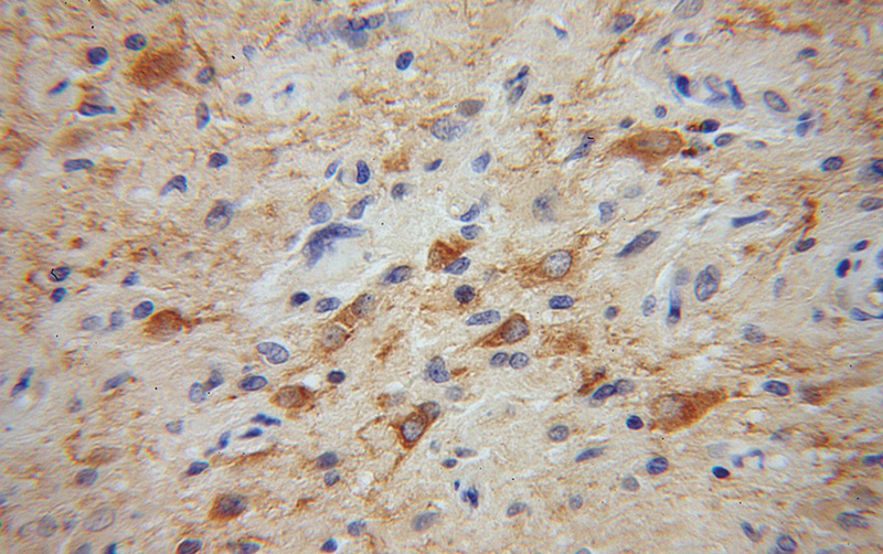 Immunohistochemical of paraffin-embedded human gliomas using Catalog No:110135(DYNC1I1 antibody) at dilution of 1:50 (under 40x lens)