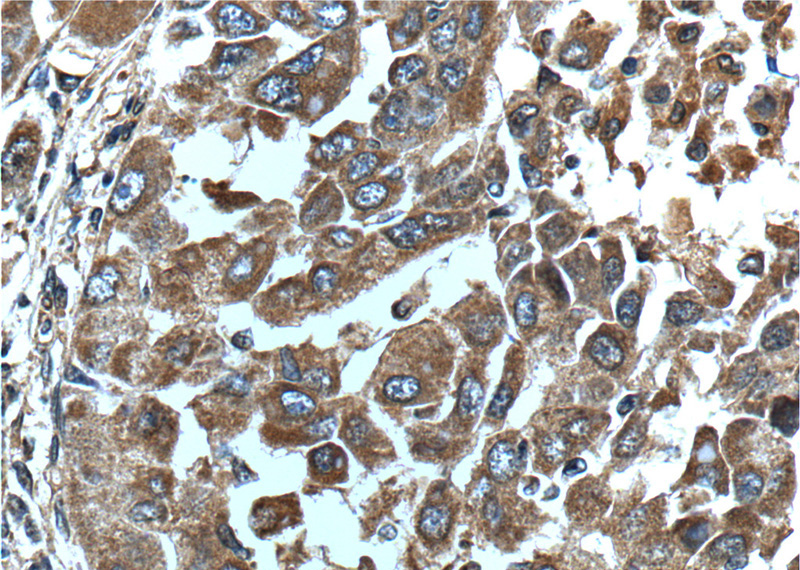 Immunohistochemistry of paraffin-embedded human liver cancer tissue slide using Catalog No:110769(GAB3-Specific Antibody) at dilution of 1:200 (under 40x lens).