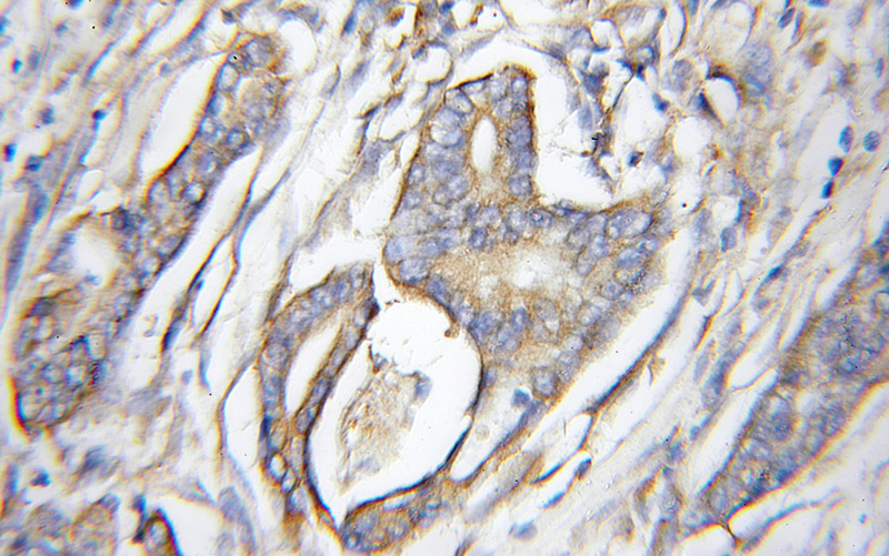 Immunohistochemical of paraffin-embedded human pancreas cancer using Catalog No:107839(AGTRAP antibody) at dilution of 1:10 (under 10x lens)