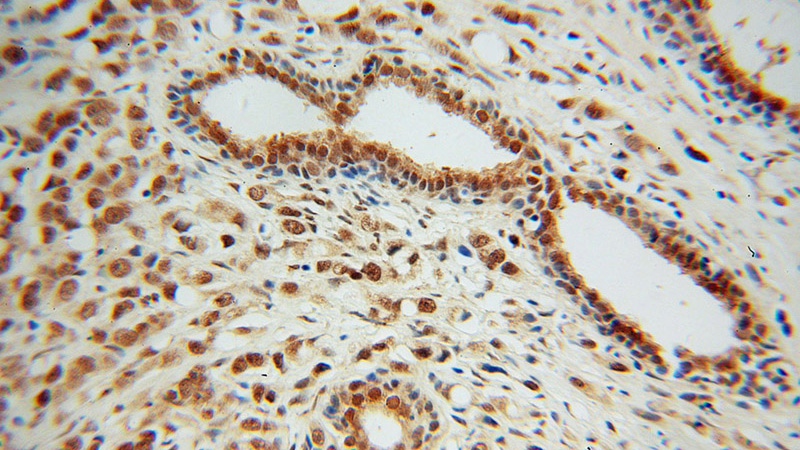 Immunohistochemical of paraffin-embedded human prostate cancer using Catalog No:109618(CSTF2T antibody) at dilution of 1:100 (under 40x lens)