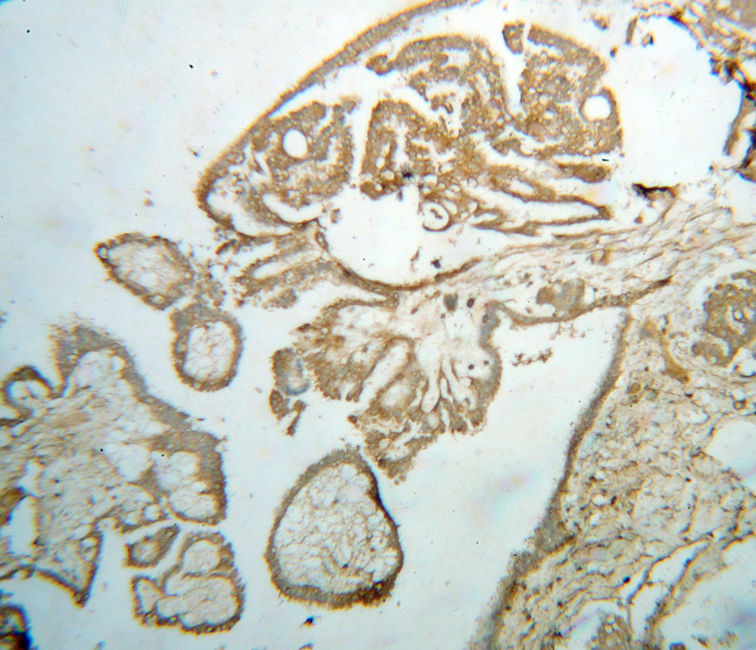 Immunohistochemical of paraffin-embedded human ovary tumor using Catalog No:107853(AIFM3 antibody) at dilution of 1:50 (under 10x lens)